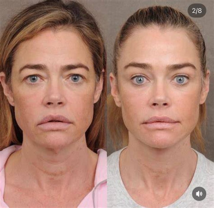 All About RHOBH Kyle Richards Plastic Surgery With Before And After Photos